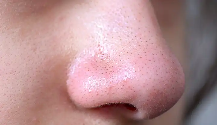 Those Tiny Dots on Your Nose Aren’t Blackheads: Dermatologist Explains What They Really Are