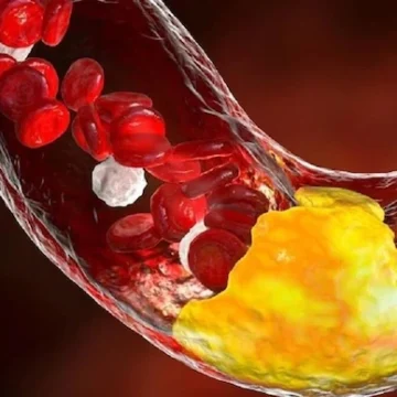 icmr-study-low-hdl-india-lipid-crisis ICMR Study: Low Good Cholesterol Drives India’s Lipid Crisis