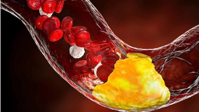 icmr-study-low-hdl-india-lipid-crisis ICMR Study: Low Good Cholesterol Drives India’s Lipid Crisis